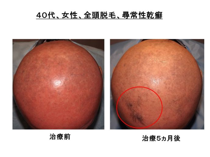 円形脱毛症　病院